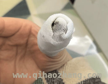 小倒刺惹出大麻烦，处理不当危害多 拔倒刺引发发炎化脓，这教训太深刻！