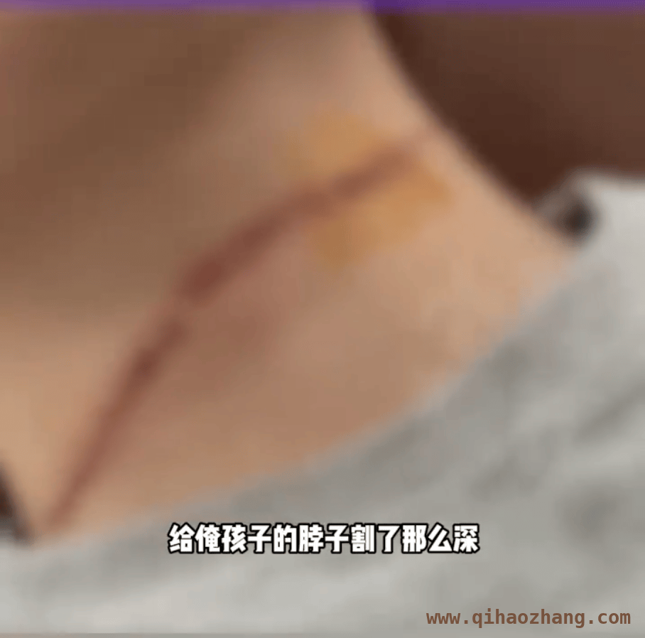 小心！紧绷风筝线成隐形杀手，多案例触目惊心 风筝线割伤事故频发，放风筝安全不容忽视