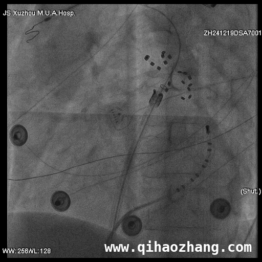 淮海经济区首台房颤一站式手术：徐州医科大学附属医院的实力彰显